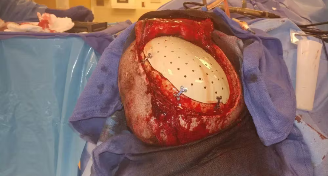Skull Reconstruction and Cranioplasty (12)