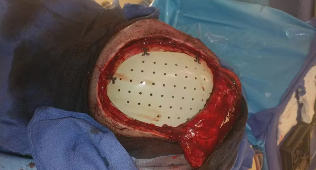 Skull Reconstruction and Cranioplasty (13)