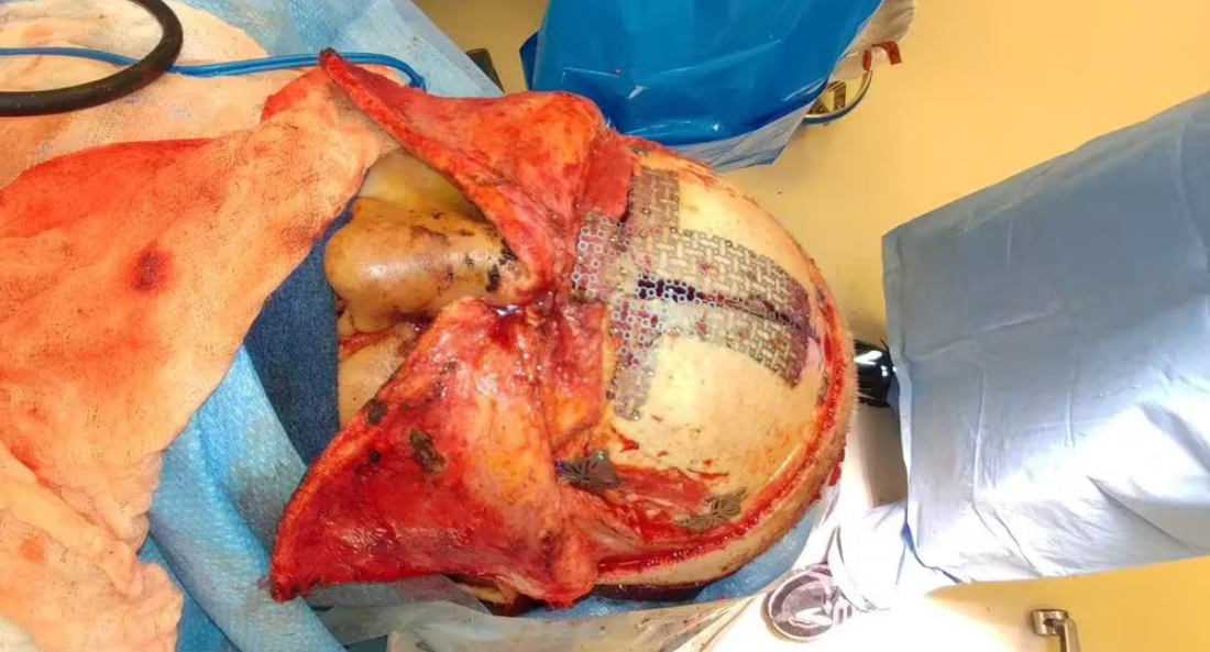 Skull Reconstruction and Cranioplasty (15)