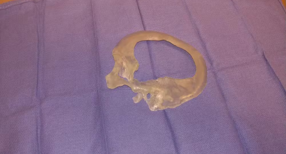 Skull Reconstruction and Cranioplasty (19)
