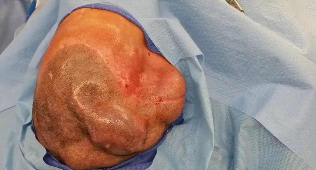 Skull Reconstruction and Cranioplasty (2)