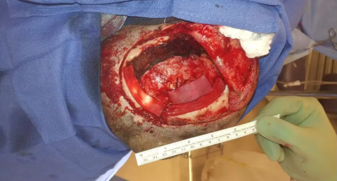 Skull Reconstruction and Cranioplasty (20)