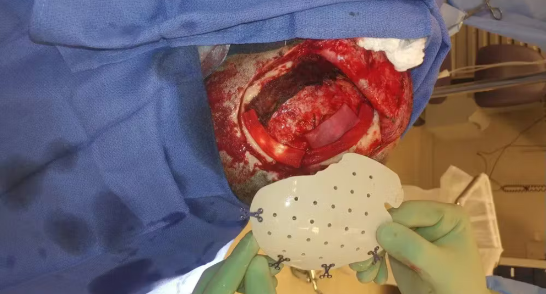 Skull Reconstruction and Cranioplasty (21)