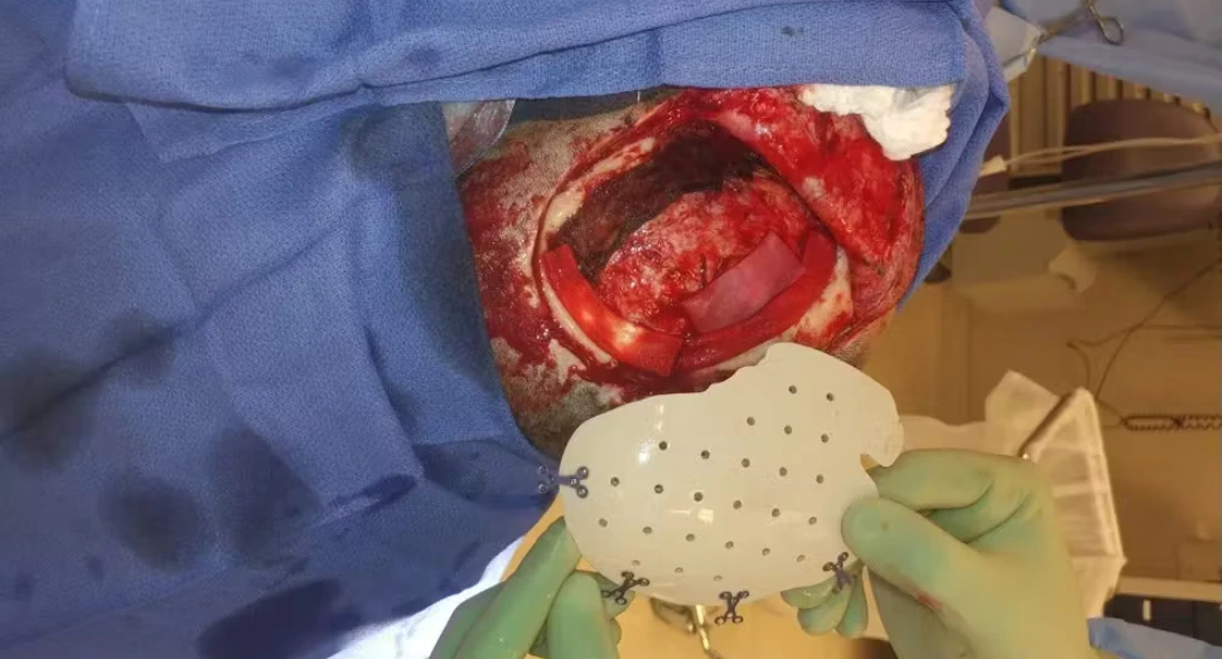 Skull Reconstruction and Cranioplasty (21)