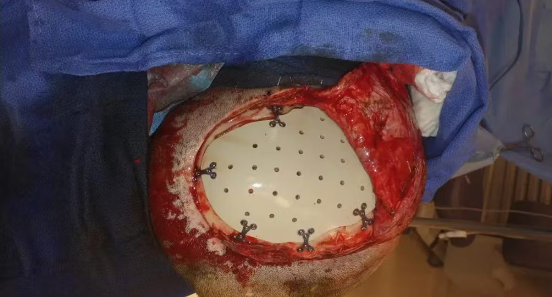 Skull Reconstruction and Cranioplasty (22)