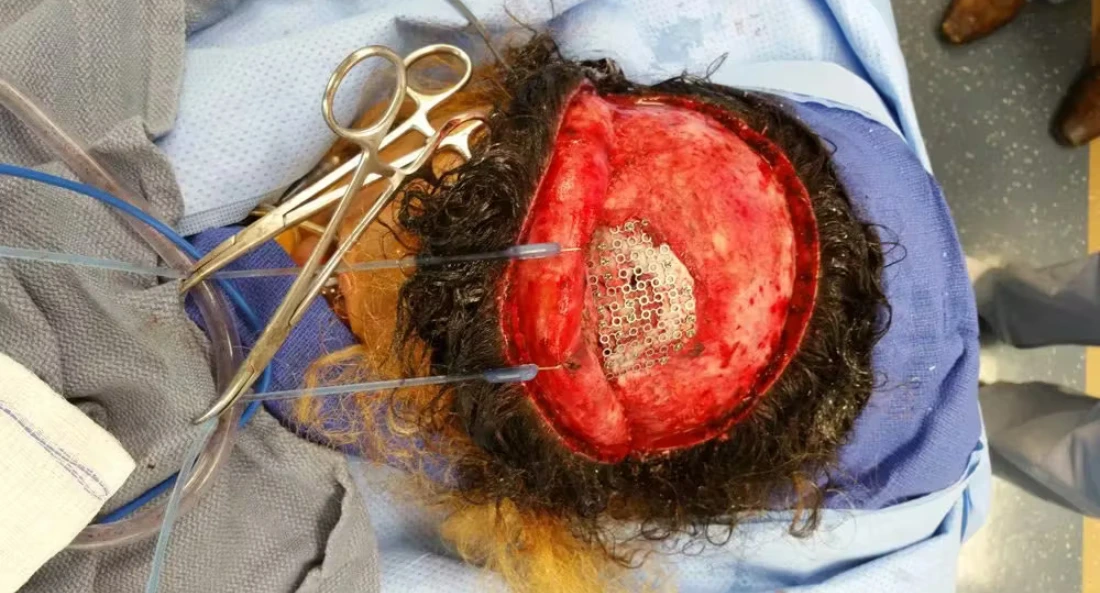 Skull Reconstruction and Cranioplasty (23)