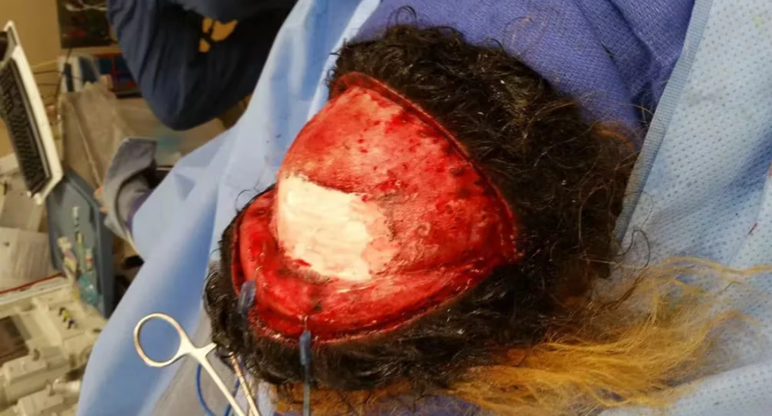 Skull Reconstruction and Cranioplasty (24)