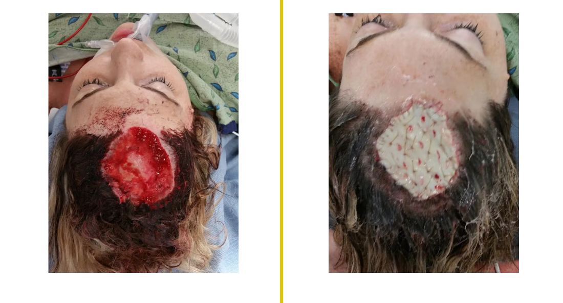 Skull Reconstruction and Cranioplasty (26)