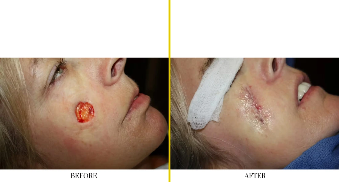 Skull Reconstruction and Cranioplasty (29)