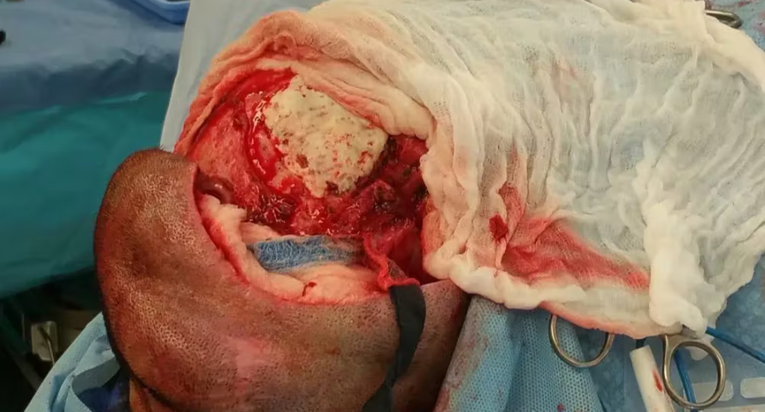 Skull Reconstruction and Cranioplasty (3)