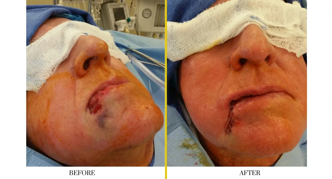Skull Reconstruction and Cranioplasty (31)