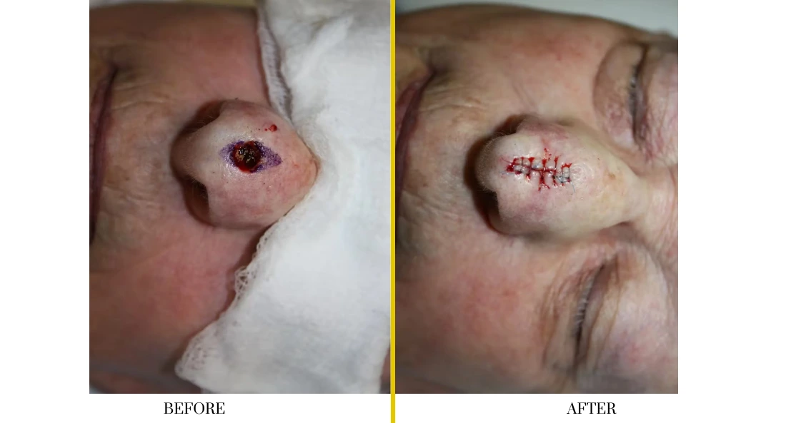 Skull Reconstruction and Cranioplasty (33)