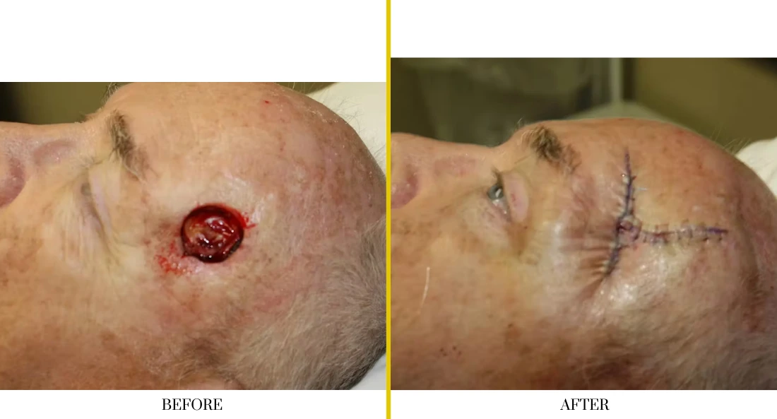 Skull Reconstruction and Cranioplasty (38)