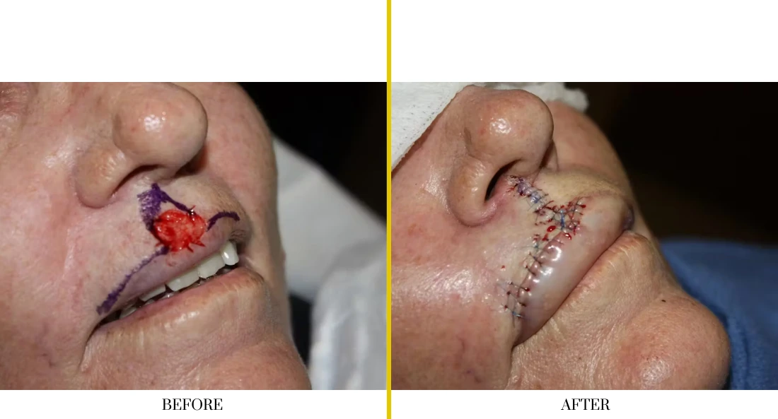 Skull Reconstruction and Cranioplasty (41)