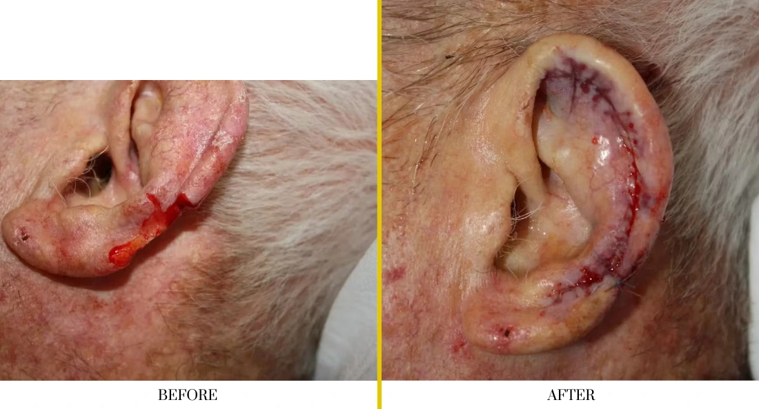 Skull Reconstruction and Cranioplasty (42)