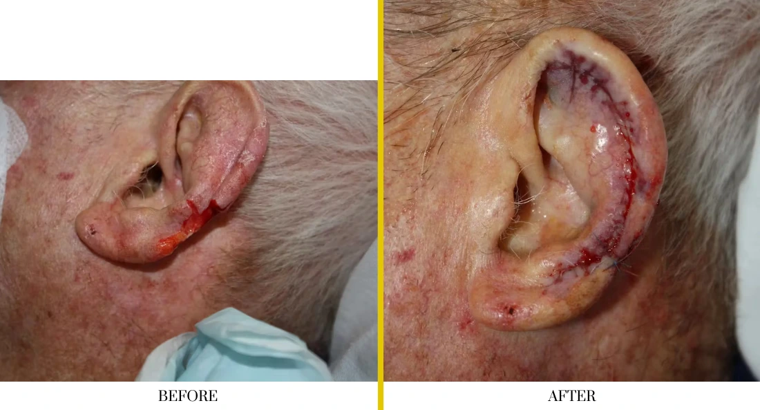 Skull Reconstruction and Cranioplasty (43)