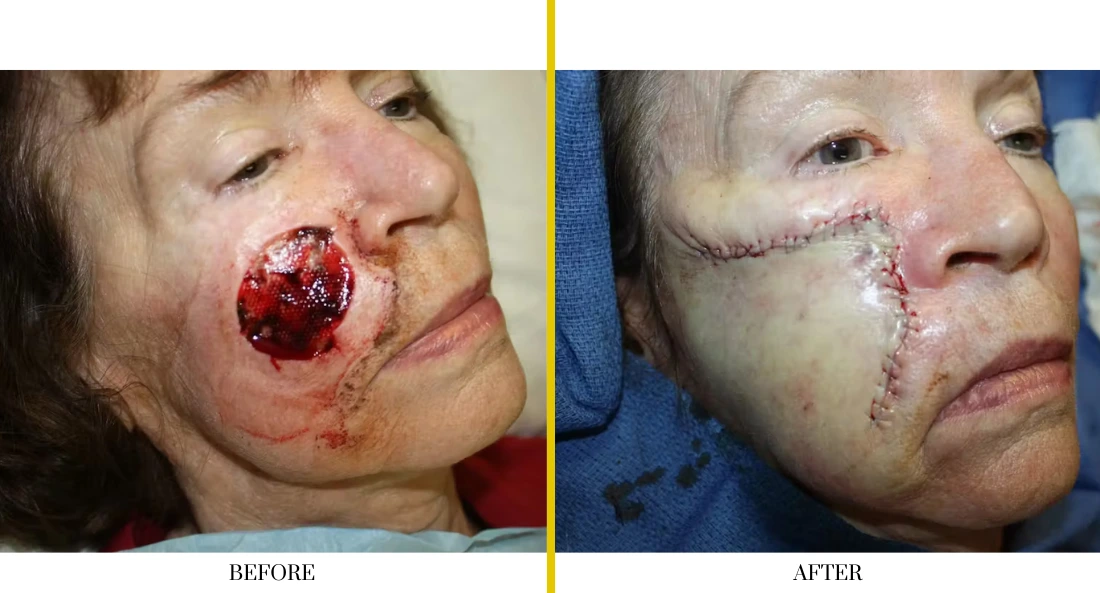 Skull Reconstruction and Cranioplasty (44)