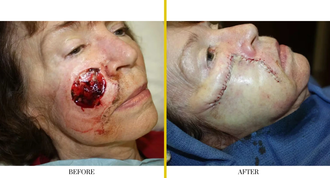 Skull Reconstruction and Cranioplasty (45)