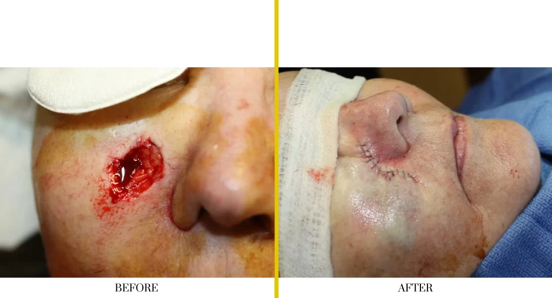 Skull Reconstruction and Cranioplasty (46)