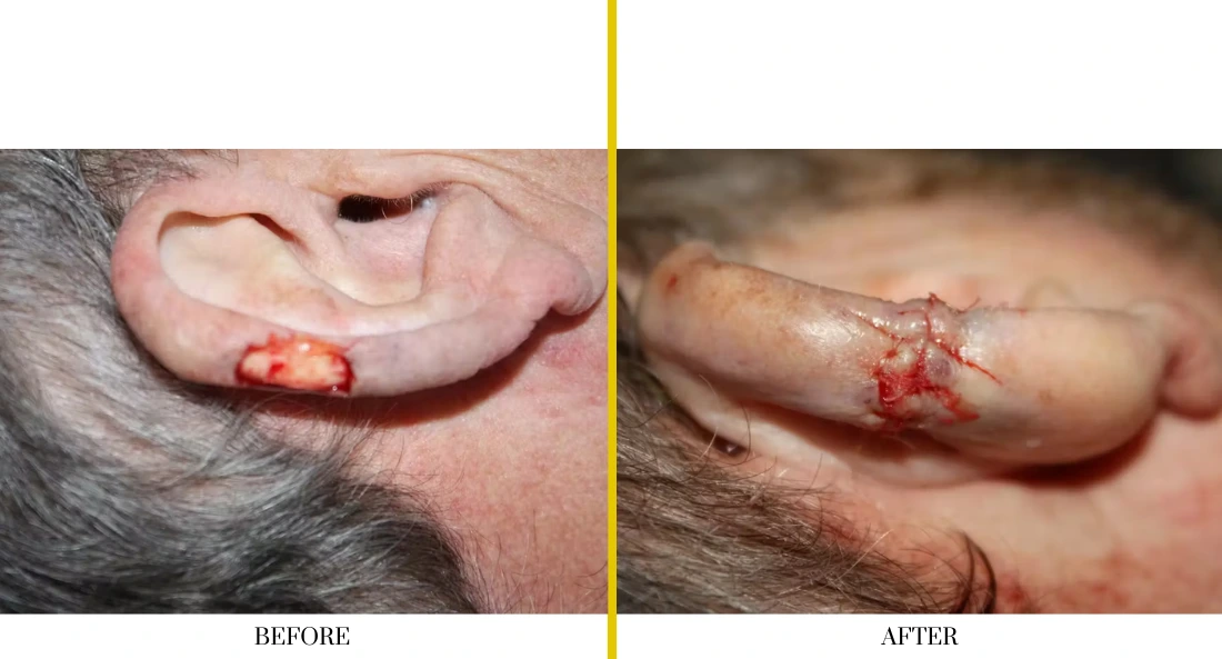 Skull Reconstruction and Cranioplasty (48)