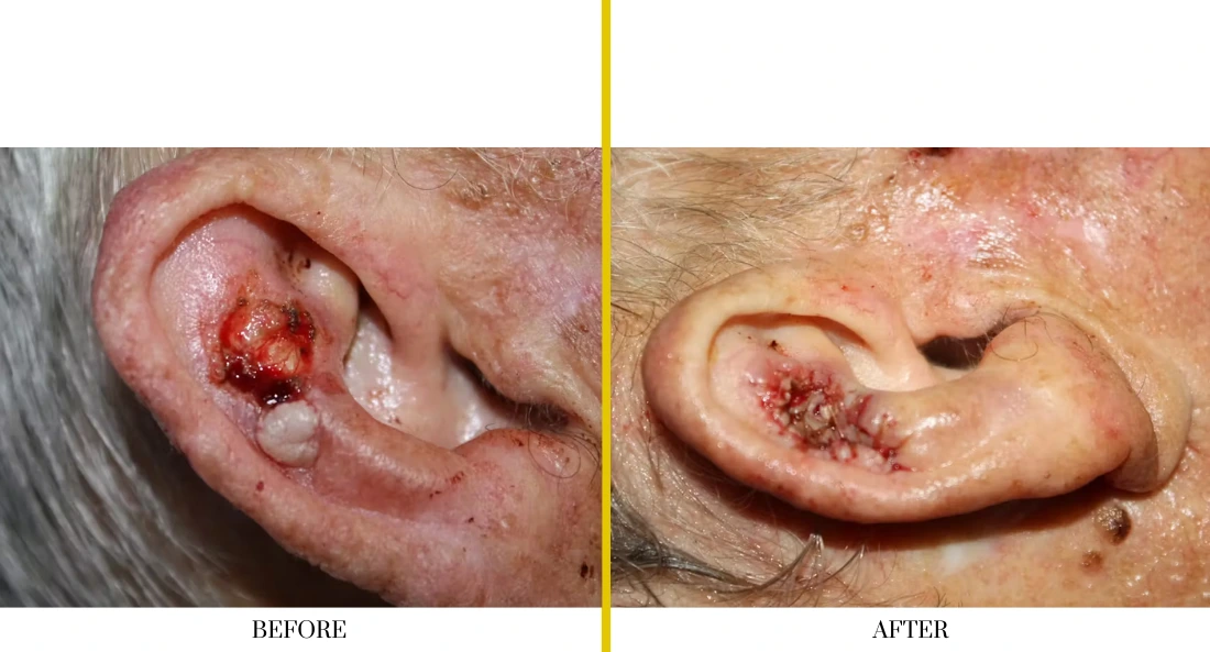 Skull Reconstruction and Cranioplasty (49)