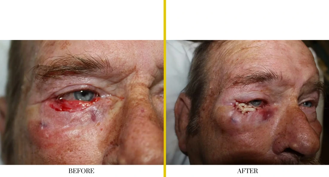 Skull Reconstruction and Cranioplasty (52)