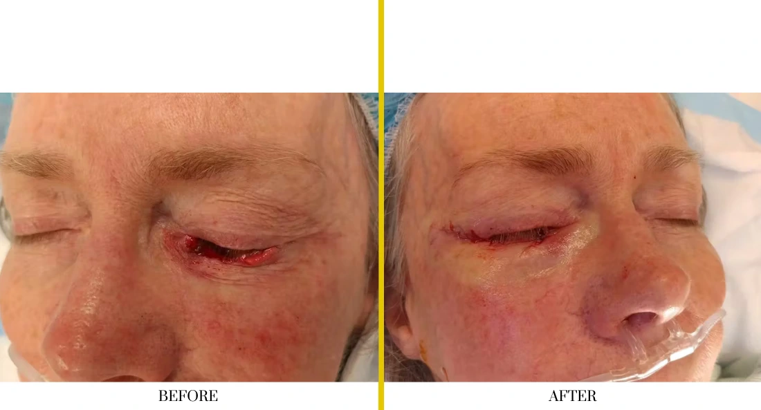 Skull Reconstruction and Cranioplasty (53)