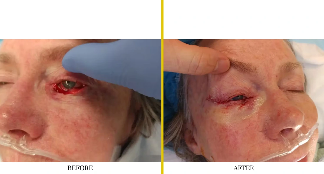 Skull Reconstruction and Cranioplasty (54)