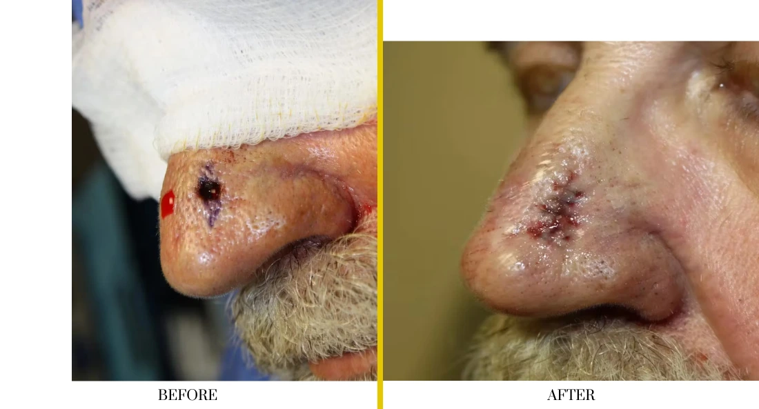 Skull Reconstruction and Cranioplasty (55)