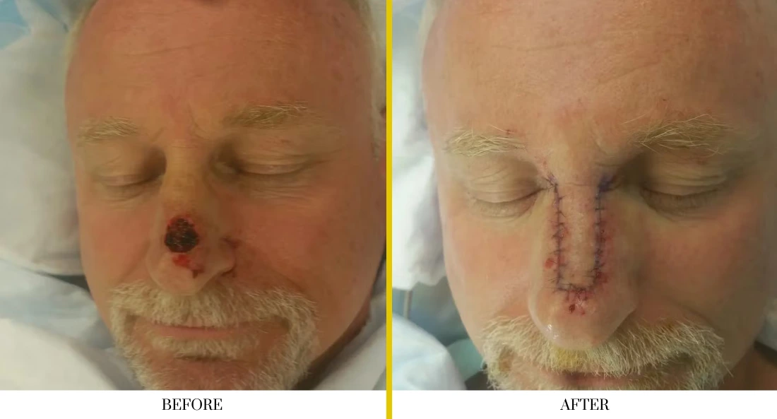 Skull Reconstruction and Cranioplasty (58)