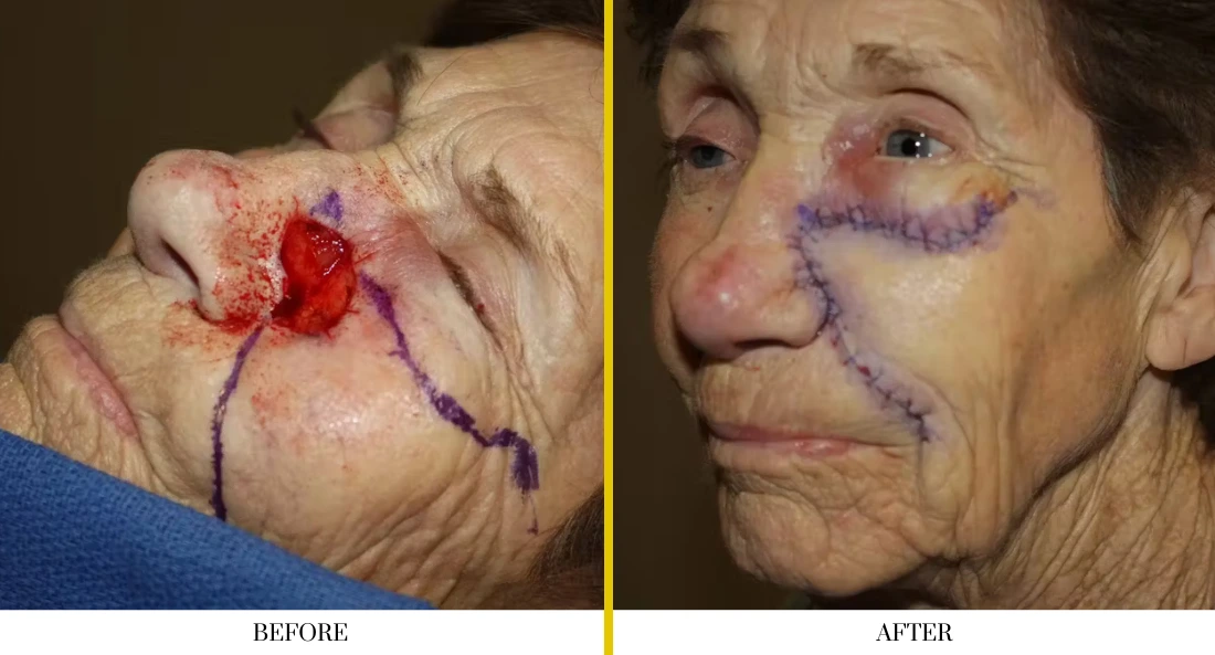 Skull Reconstruction and Cranioplasty (59)