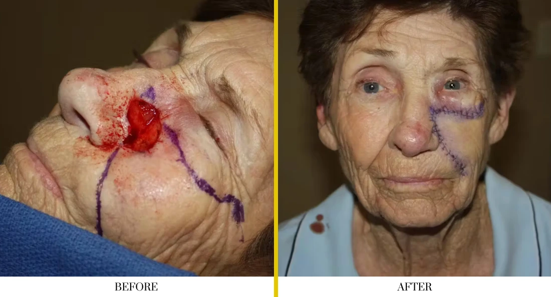 Skull Reconstruction and Cranioplasty (60)