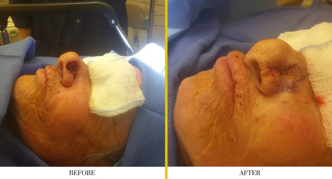 Skull Reconstruction and Cranioplasty (61)