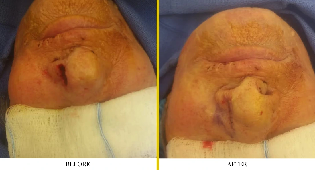 Skull Reconstruction and Cranioplasty (62)