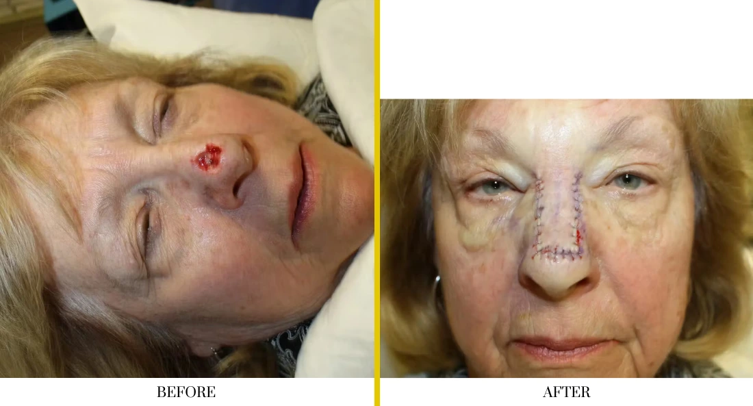 Skull Reconstruction and Cranioplasty (64)