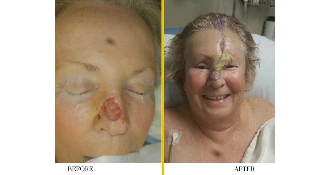 Skull Reconstruction and Cranioplasty (65)