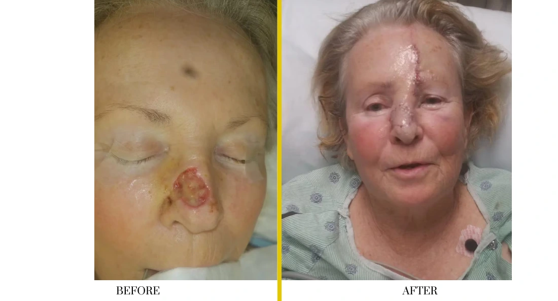Skull Reconstruction and Cranioplasty (67)