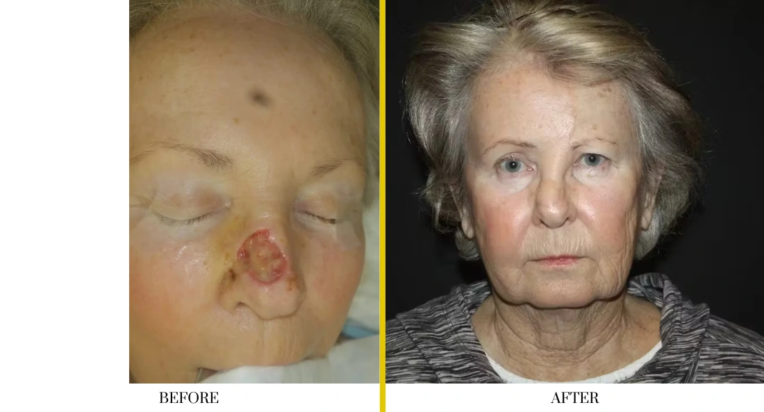 Skull Reconstruction and Cranioplasty (68)