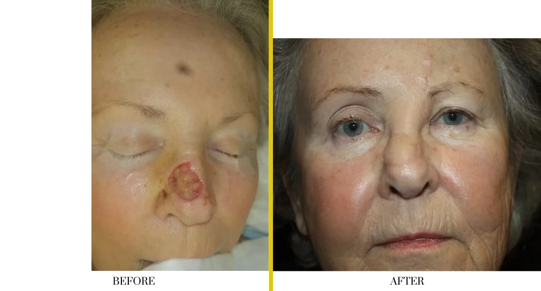 Skull Reconstruction and Cranioplasty (69)