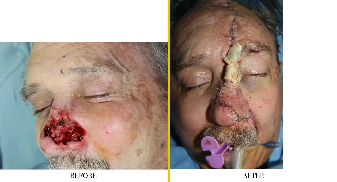 Skull Reconstruction and Cranioplasty (70)