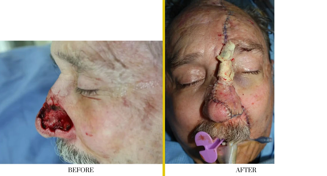 Skull Reconstruction and Cranioplasty (71)