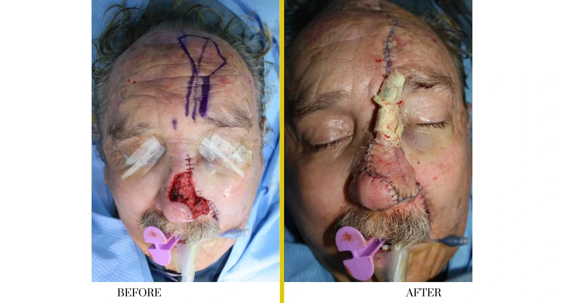 Skull Reconstruction and Cranioplasty (72)