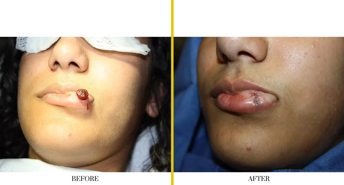 Skull Reconstruction and Cranioplasty (73)