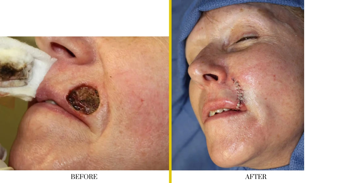 Skull Reconstruction and Cranioplasty (75)