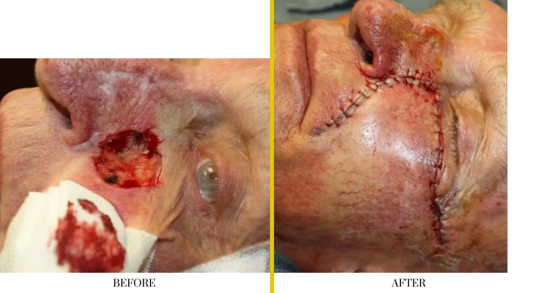 Skull Reconstruction and Cranioplasty (76)