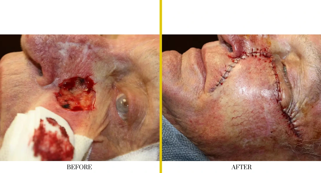 Skull Reconstruction and Cranioplasty (77)