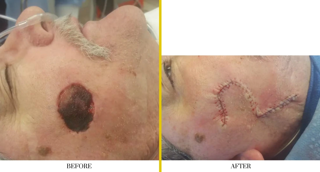 Skull Reconstruction and Cranioplasty (78)