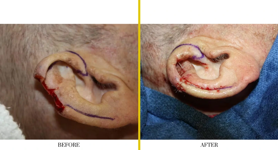 Skull Reconstruction and Cranioplasty (79)