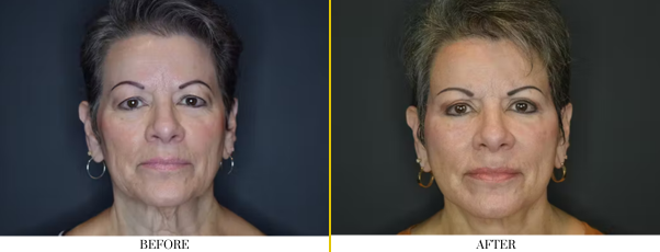 neck lift 1.2