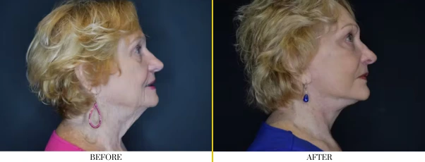 neck lift
